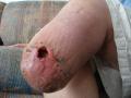 Amputace je �asto jedin�m �e�en�m ischemick� chotoby doln�ch kon�etin �i tzv. diabetick� nohy